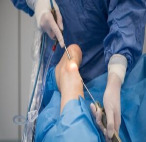 Achilles Tendon Surgery And What You Need to Know