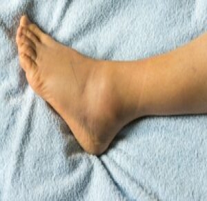 End Stage Ankle Arthritis